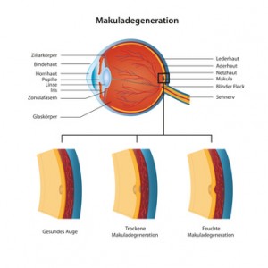 makuladegeneration vektor illustration deutsch mit beschreibung