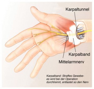 Ein Schaubild über die Anatomie der Hand mit sichtbarem Karpaltunnel