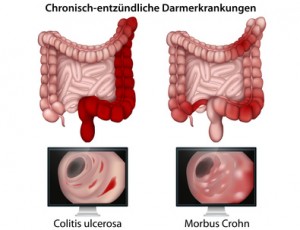 zwei schematisch dargestellte Därme, dargestellt ist der unterschiedliche Befall der Darmabschnitt von Morbus crohn und colitis ulcerosa Dagmar Klein, Unterstützung bei entzündlichen Darmerkrankungen